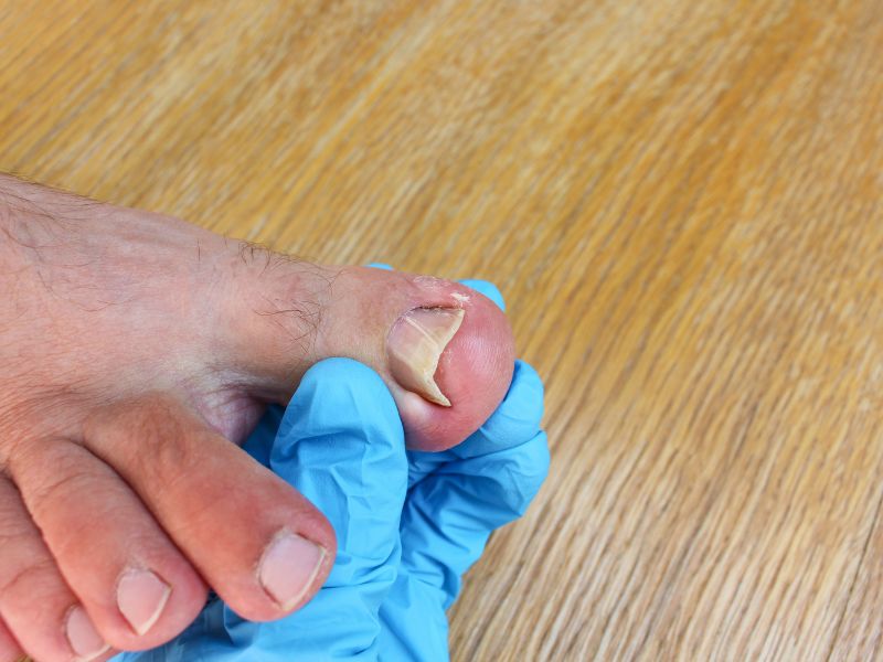 Will An Ingrown Toenail Eventually Grow Out?